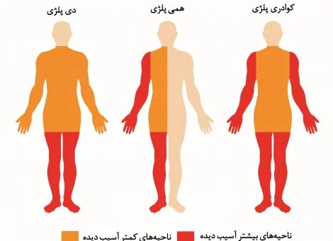همی پارزی چیست؟