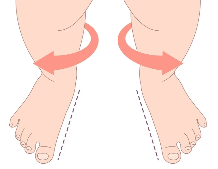 انحراف پا به بیرون کودک (Out-toeing) چیست؟ انحراف پا به بیرون کودک (Out-toeing) چیست؟
